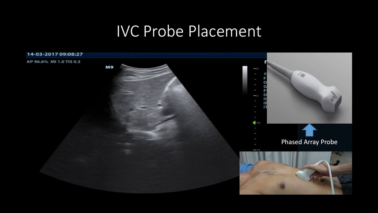 Acute Heart Failure Ultrasound