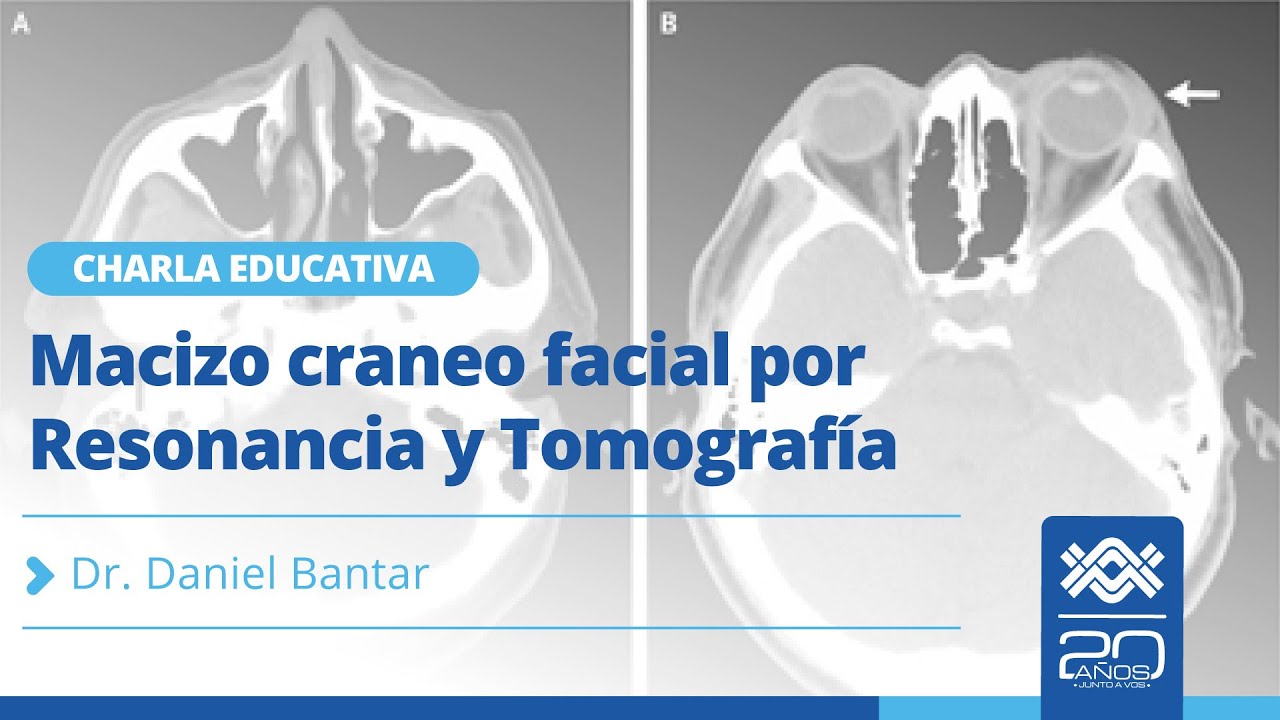 Macizo cráneo facial por Resonancia y Tomografía
