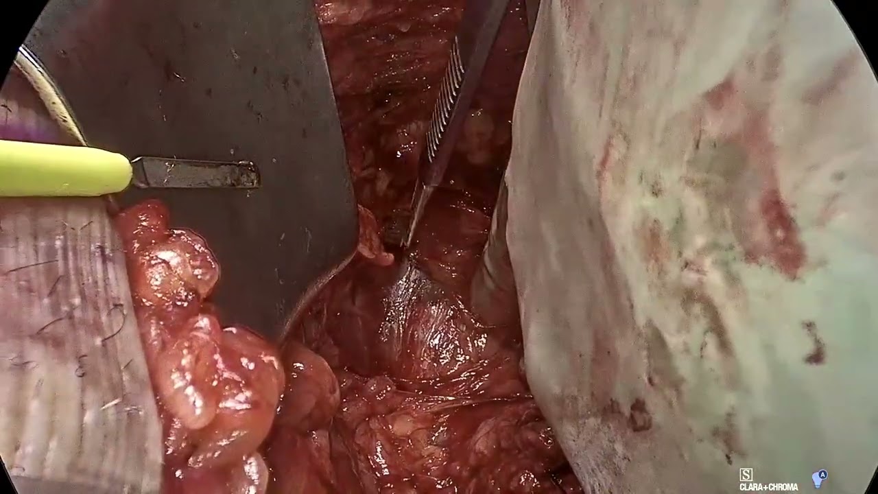 Core Videos (2024): Open Radical Cystoprostatectomy