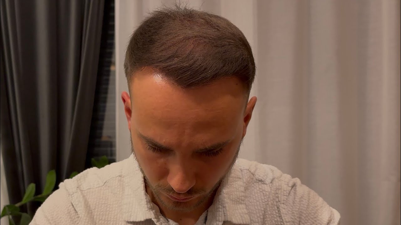 Endergebnis!? Bin ich zufrieden? Haartransplantation bei ELITHAIR in Istanbul