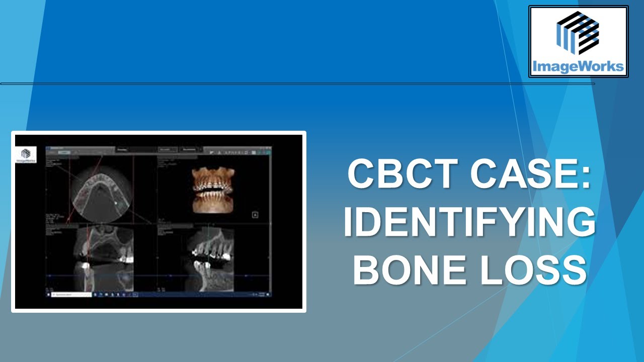 CBCT Case:  Identifying bone loss
