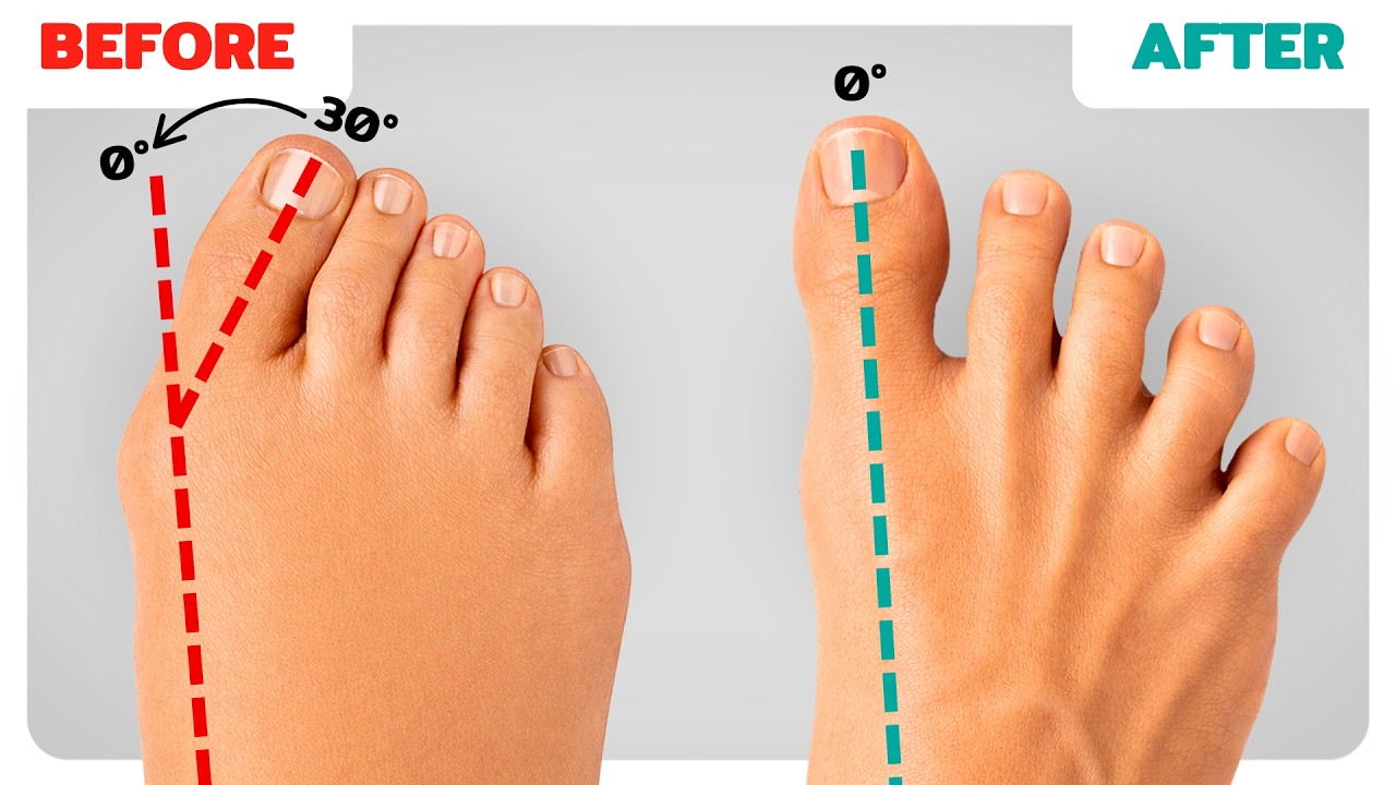 99% of People STILL Don’t Know the Basics of Fixing Bunions