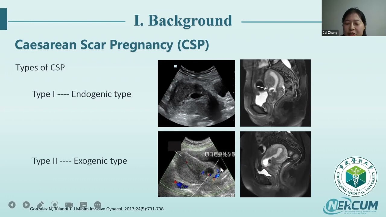 HIFU followed by D&C to treat caesarean scar pregnancy: clinical protocol and outcomes