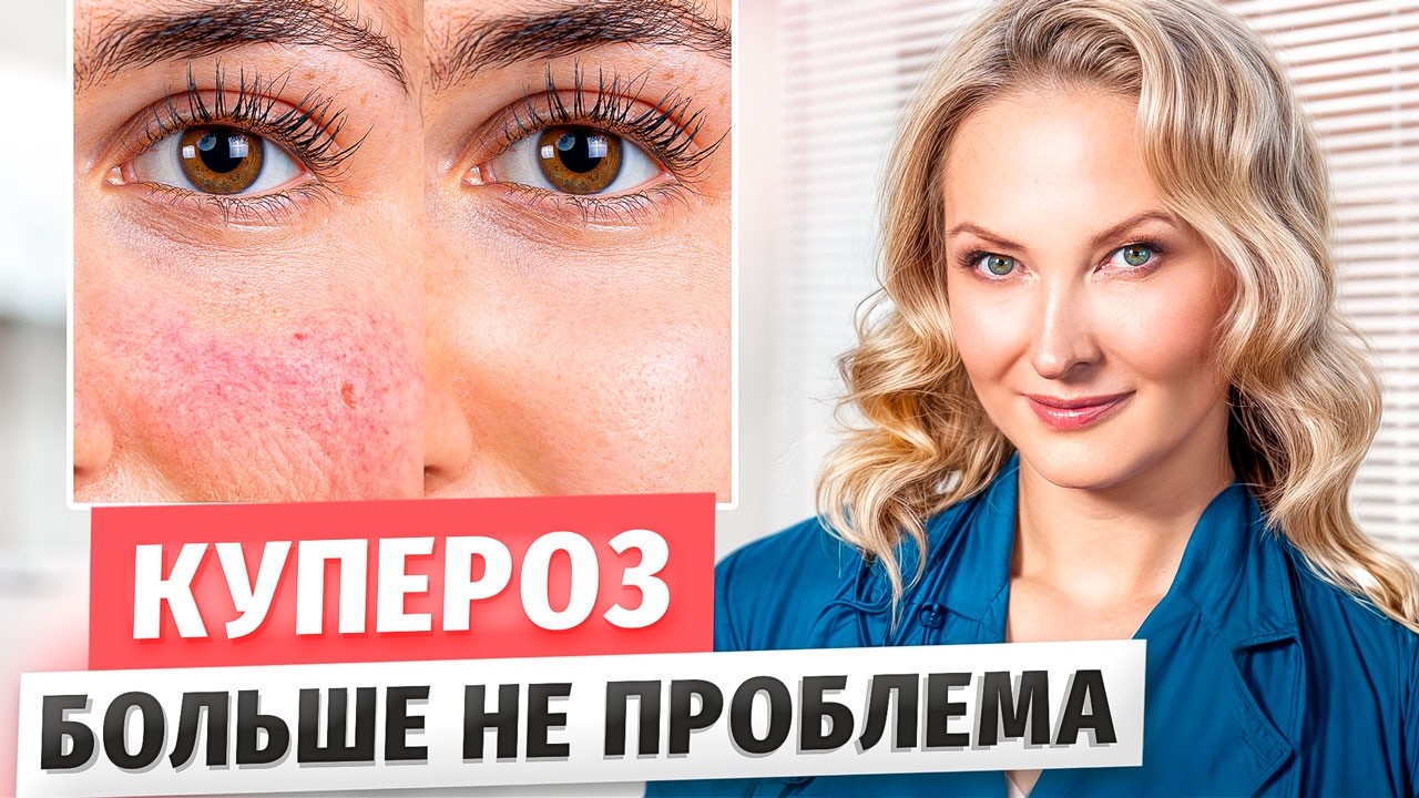 Как избавиться от сосудов на лице? Лечение КУПЕРОЗА и РОЗАЦЕА - Вены под глазами