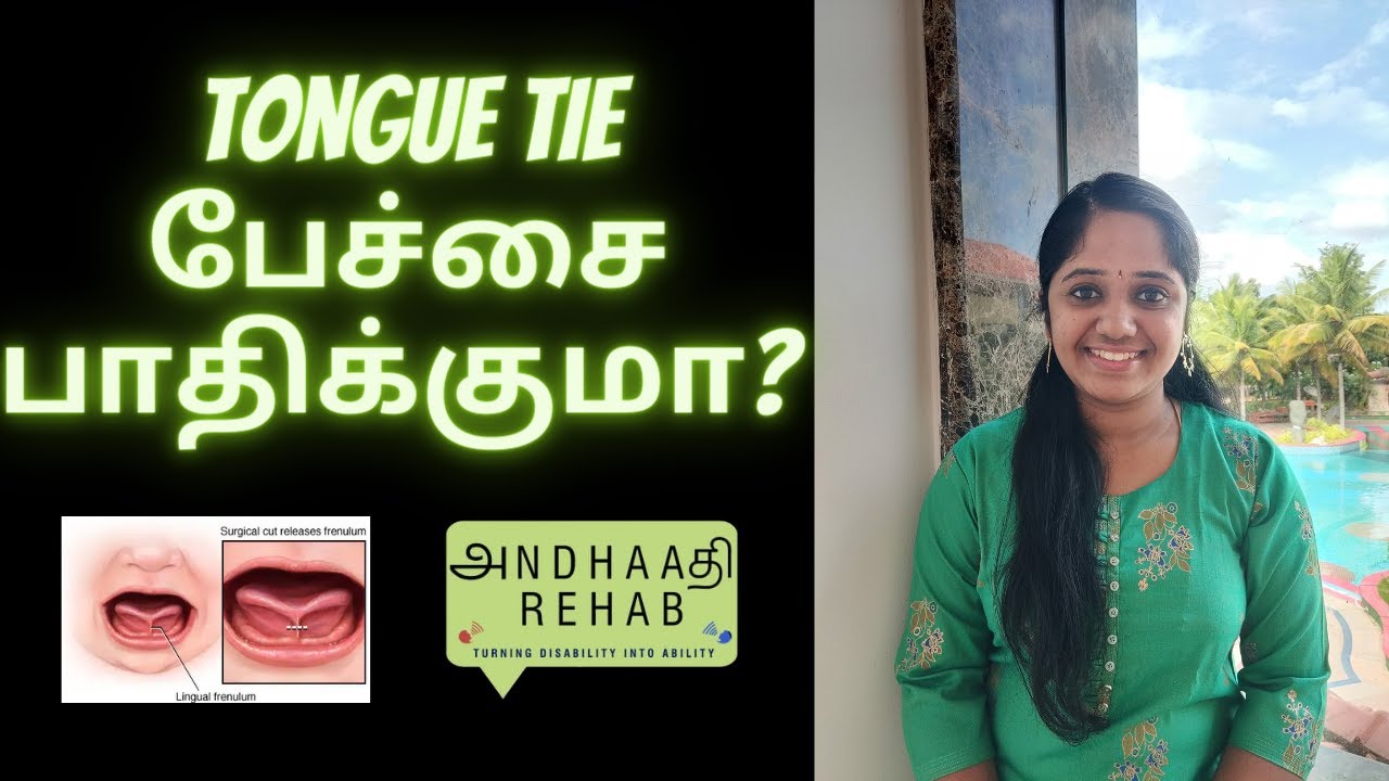 Tongue tie [ ANKYLOGLOSSIA ] in children affects Speech clarity ? தமிழில்  | பேச்சுப் பயிற்சி