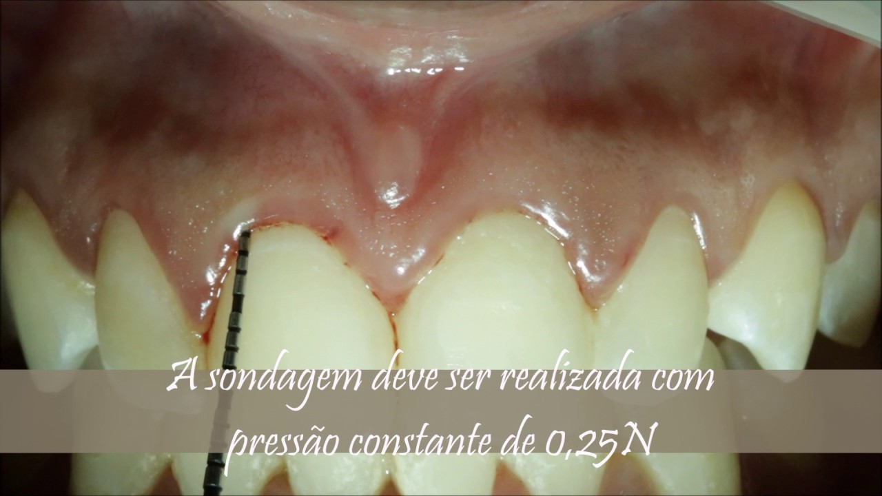 Caso cl&iacute;nico de sondagem periodontal