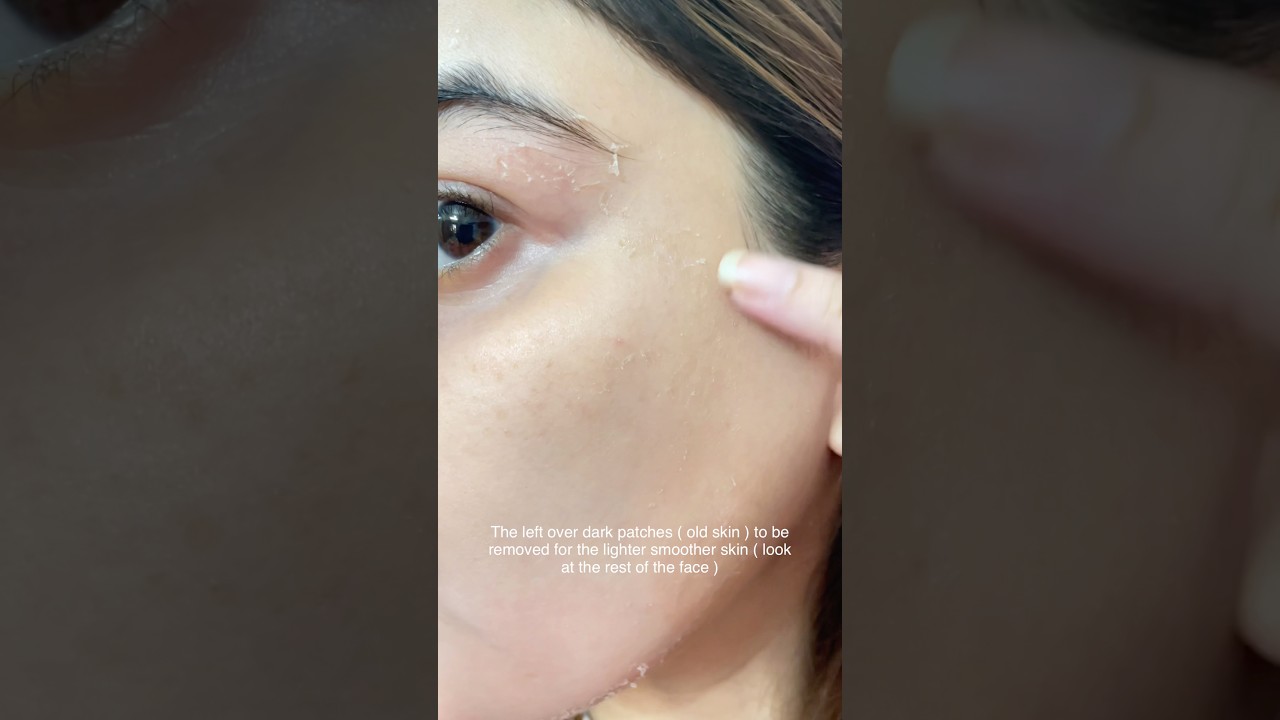 Process and results of Retinol😍 