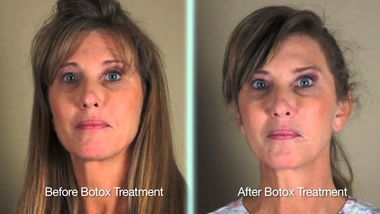 Botox for Synkinesis | Bell's Palsy Patient Testimonial