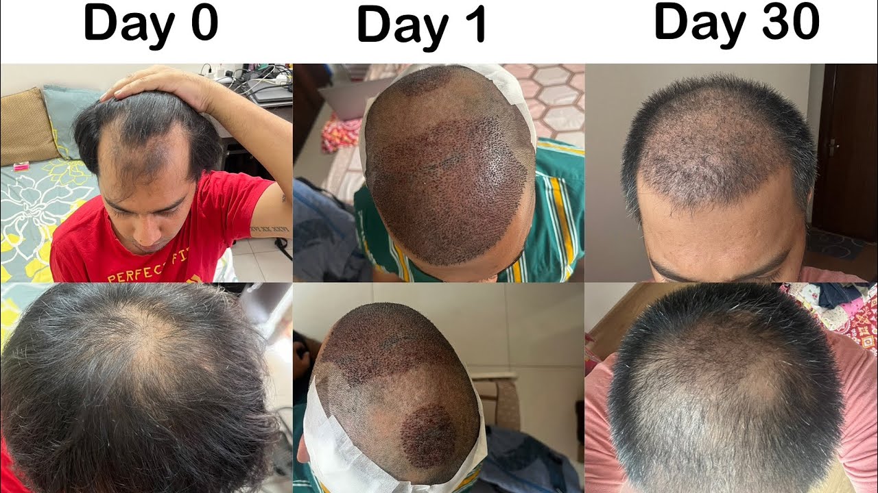 My Hair transplant journey- 1st month completion (Before and After) #transplantlife #hairtransform