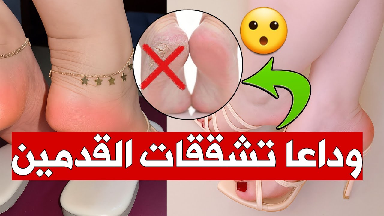 🔥 وداعاً تشقق القدمين... علاج سحري طبيعي يخلي رجليك حرير