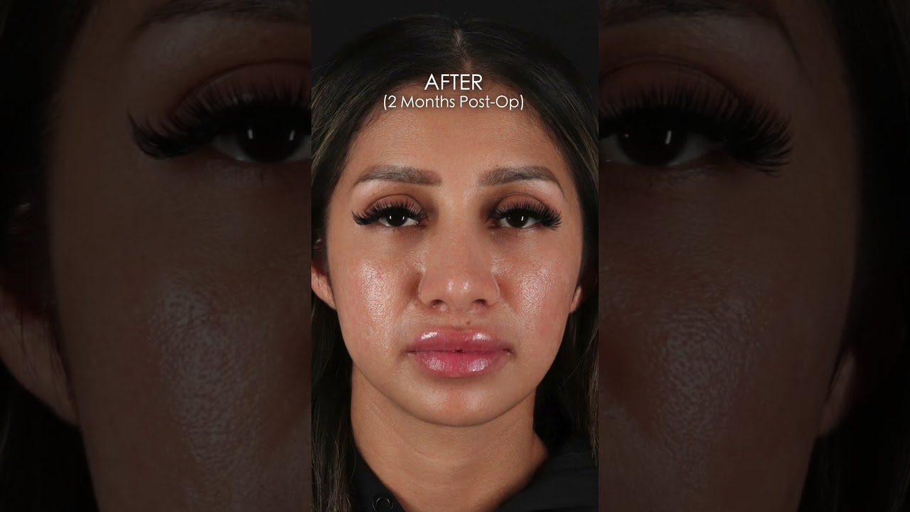 9-Months Post-op Rhinoplasty! 👃🏼❤️‍🩹