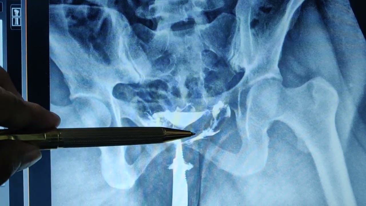 HSG HYSTEROSALPINGOGRAPHY #test #hsgtest #sheetalchhaya #scdhomecare #ajaykaushik #bestlab