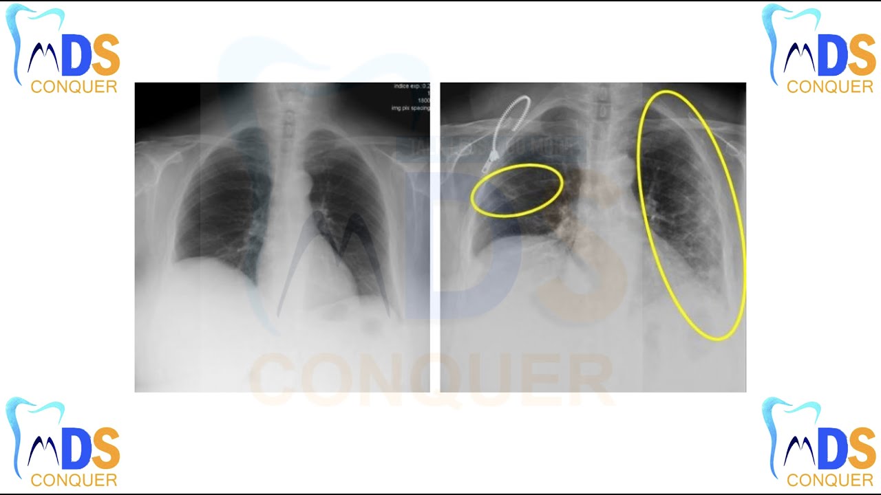 COVID 19 || NEET MDS 2020-21 || INICET MDS 2021 || QUICK RECAP