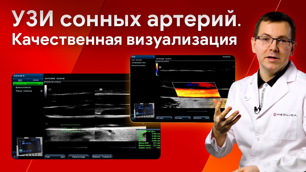 Сонные артерии на УЗИ: B-режим, Color и PW-допплер, базовая линия, комплекс интима-медиа
