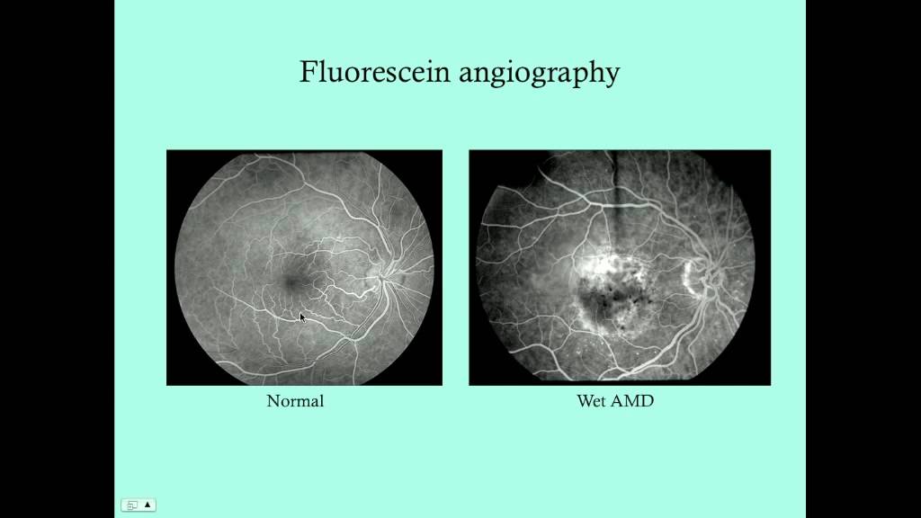 Macular Degeneration - CRASH! Medical Review Series