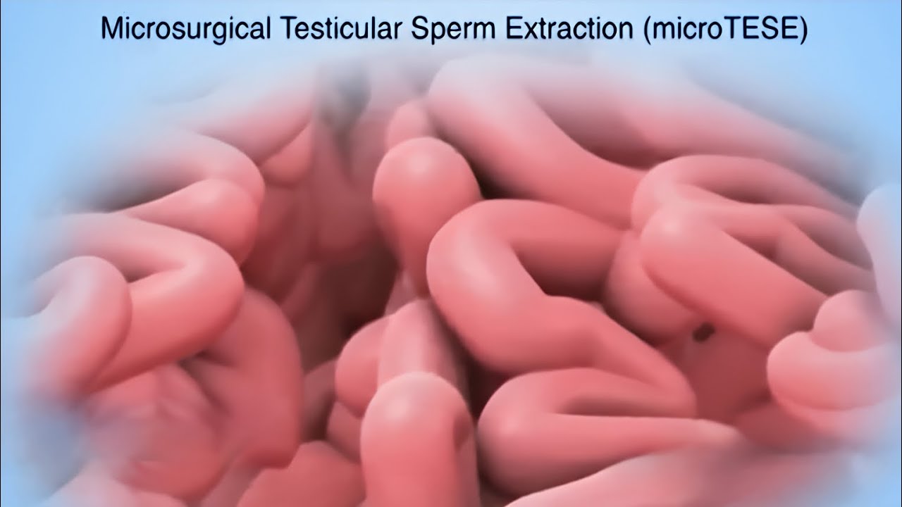 Mikrochirurgiczna ekstrakcja plemnik&oacute;w z jądra | Micro-TESE #lekarz #medycyna #edukacja #wideo #a...