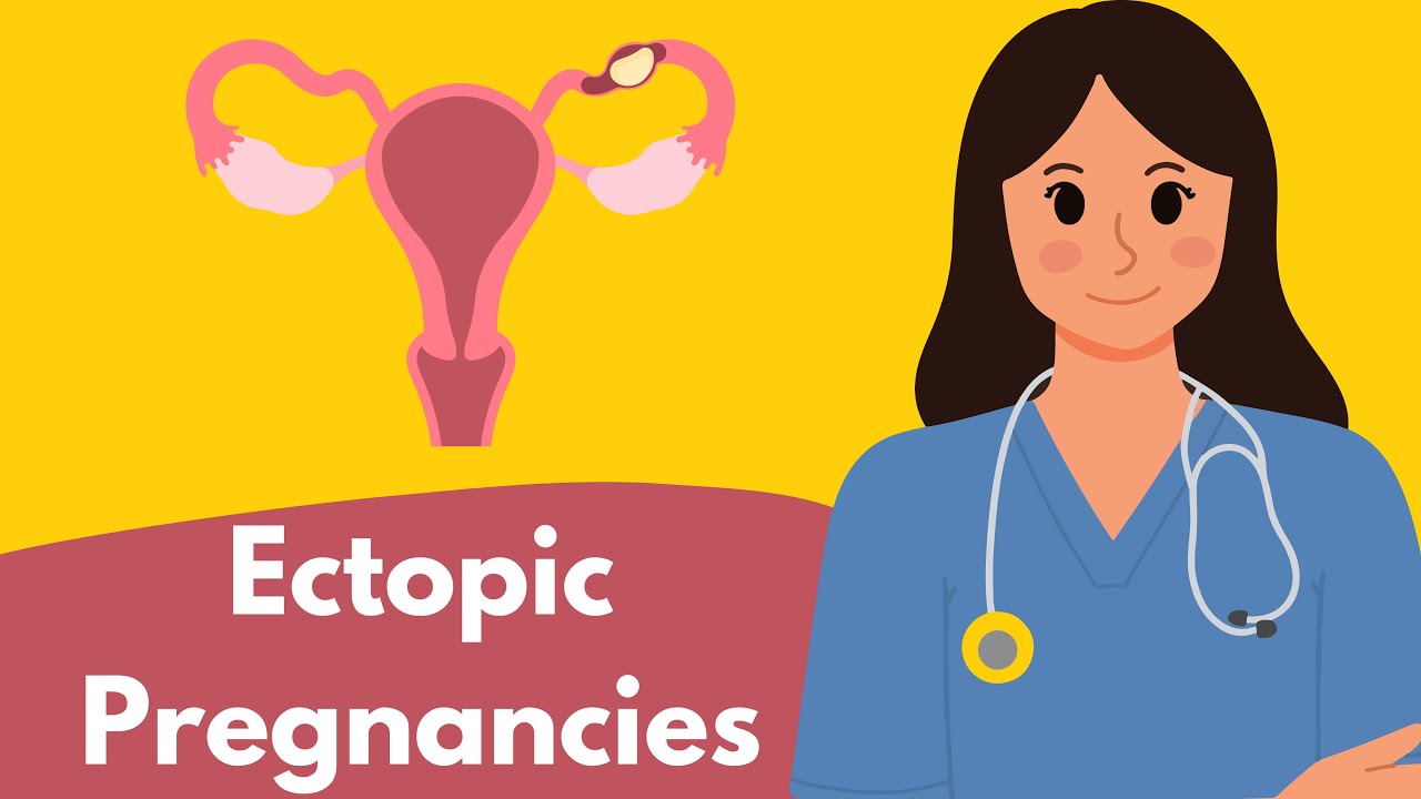Ectopic Pregnancies and why they are So Dangerous?