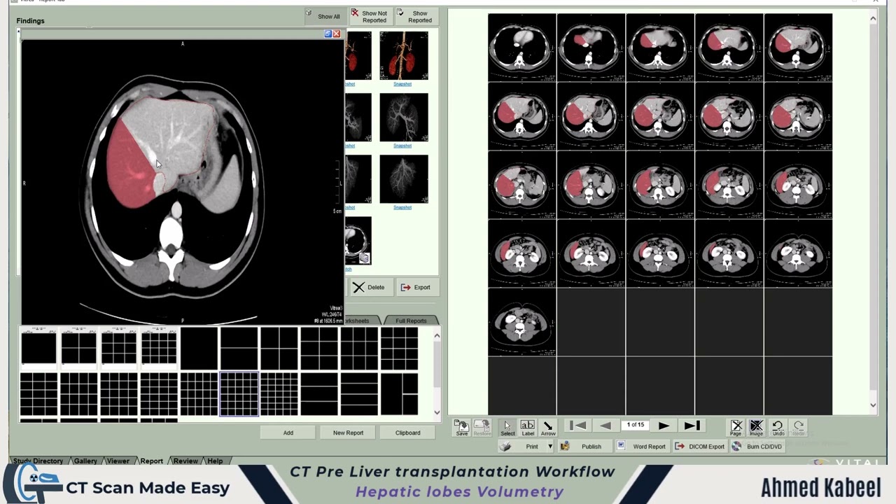 CT Pre Liver Transplantation Workflow (Volumetry For Hepatic Lobes)
