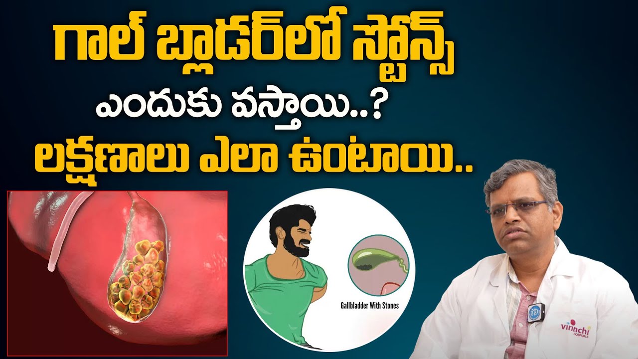 Gallbladder Stones Causes,Symptoms | How To Remove Gallbladder Stone | iDream Health
