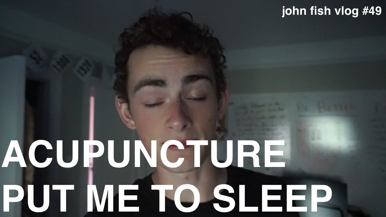 ACUPUNCTURE PUT ME TO SLEEP