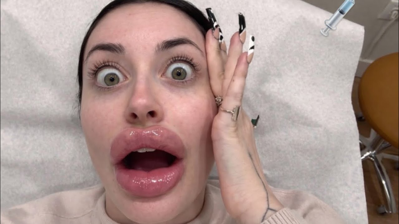 I GOT BOTOX FOR THE FIRST TIME… *I WAS NOT PREPARED*