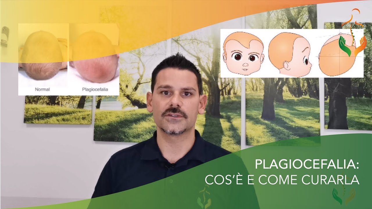 👶ESERCIZI PER PLAGIOCEFALIA NEI BAMBINI: COME CURARLA E PREVENIRLA