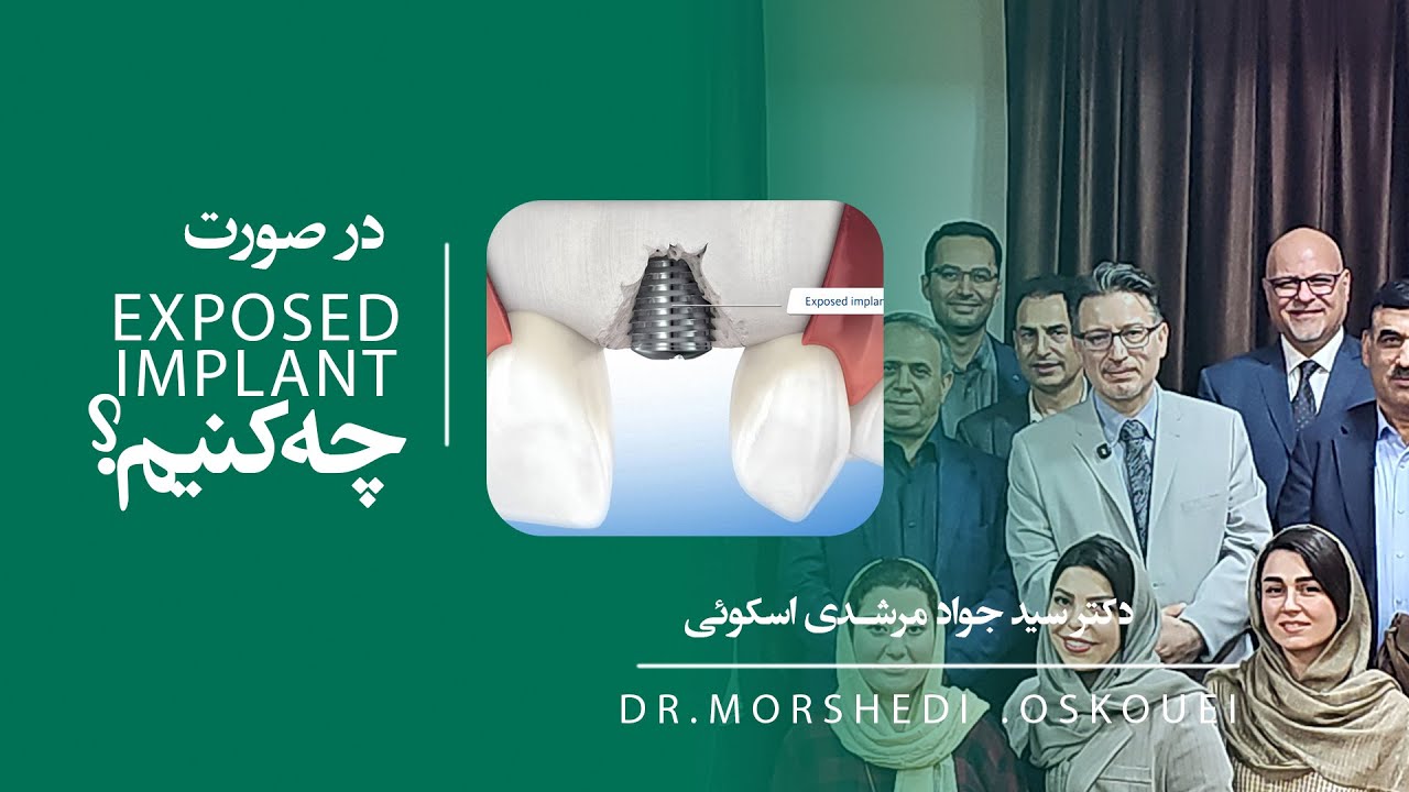 exposed Implant  راه حل