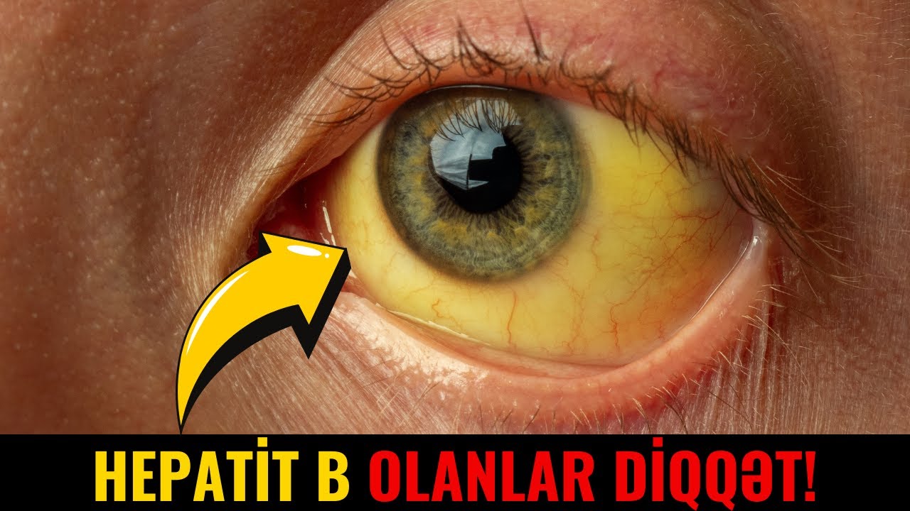 Hepatit B xəstələri nələrə diqqət etməlidir?