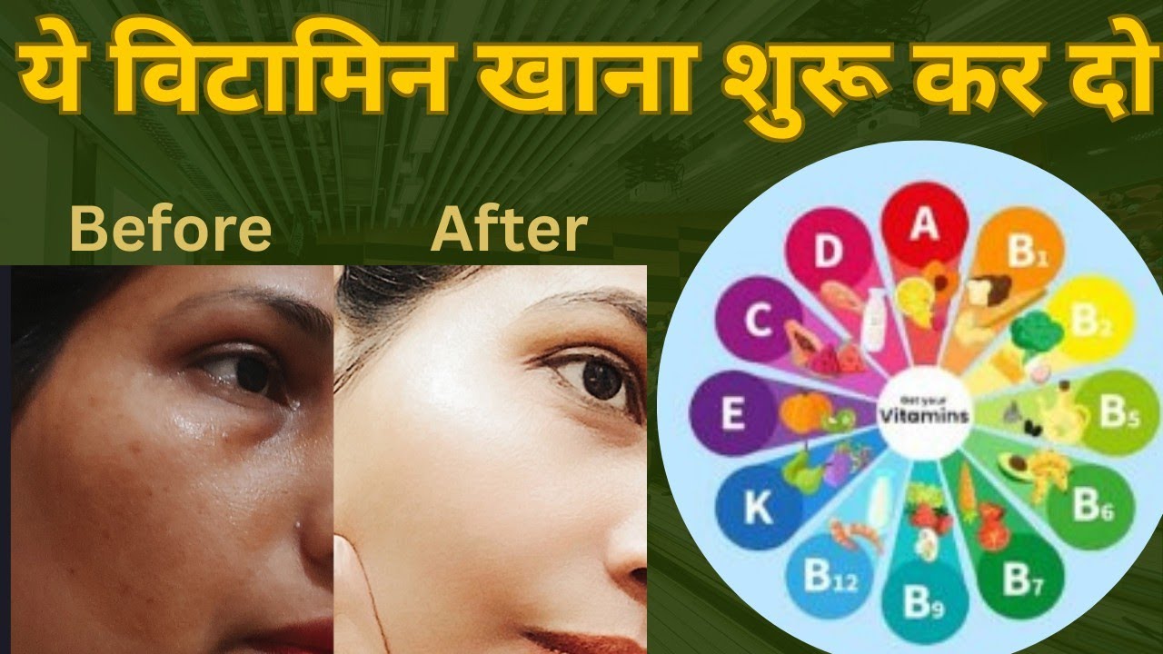 कौन से विटामिन से झाईया होती हैं। इसे कैसे ठीक करे। @vanshika ka corner