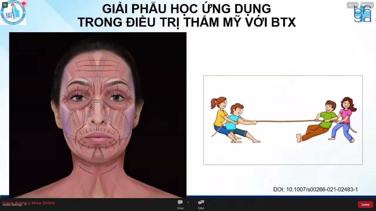 TIÊM XÓA NHĂN BẰNG BOTULINUM TOXIN TYPE A SAO CHO HIỆU QUẢ? ThD. BS. Nguyễn Phương Thảo