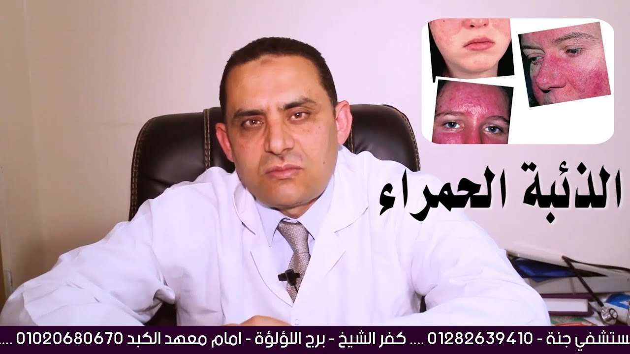 الذئبة الحمراء التشخيص وطرق العلاج د عبدالقوى مغازى استاذ م الروماتيزم والمناعة جامعة القاهرة