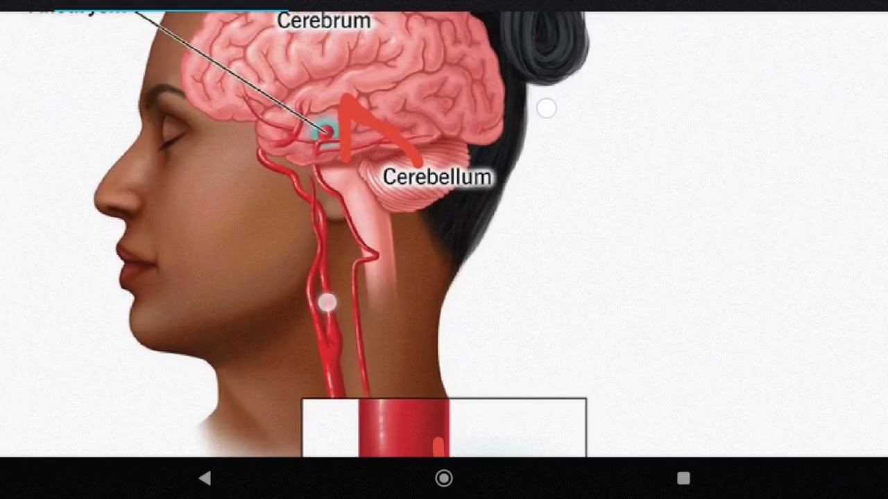 Term, CNs, part 2 || Dr. Obada Alayed