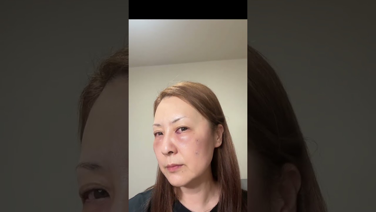 ５０代　目の下クマ取り手術　※ダウンタイム閲覧注意！！