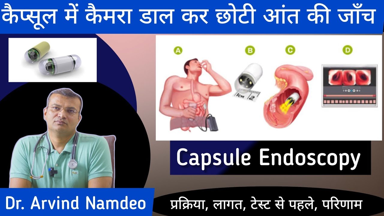 कैप्सूल एंडोस्कोपी क्या होती है ? | Capsule Endoscopy (Camera) : क्यों की जाती है ?