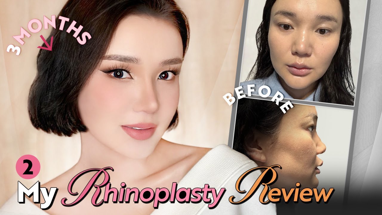 [Part-2] Mongolian Actress Zolzaya/3Months after surgery RESULTS update/NANA plastic surgery
