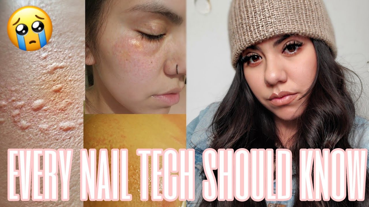 NAIL TECH ALLERGIC TO ACRYLIC!!!!! | WORSE THING EVER!!!!! what help my acrylic allergies.