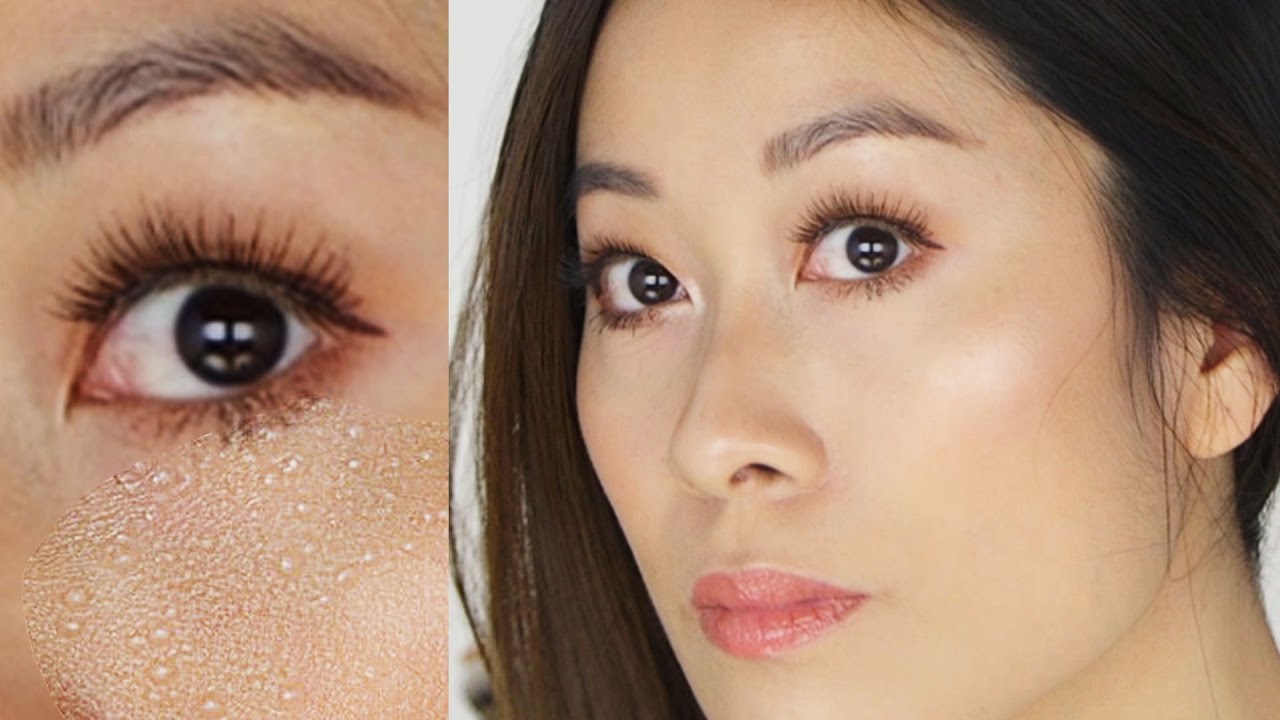 How To Get Rid of Milia | Vivienne Fung