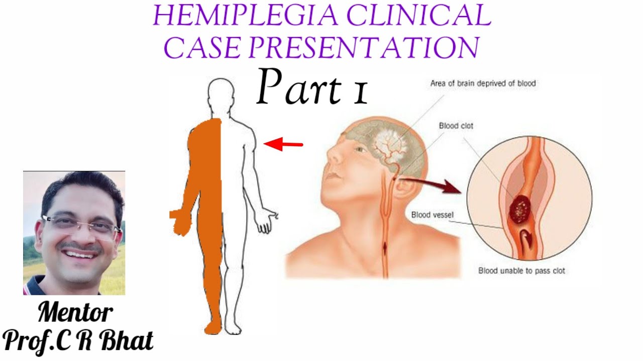 HEMIPLEGIA (Part 1)