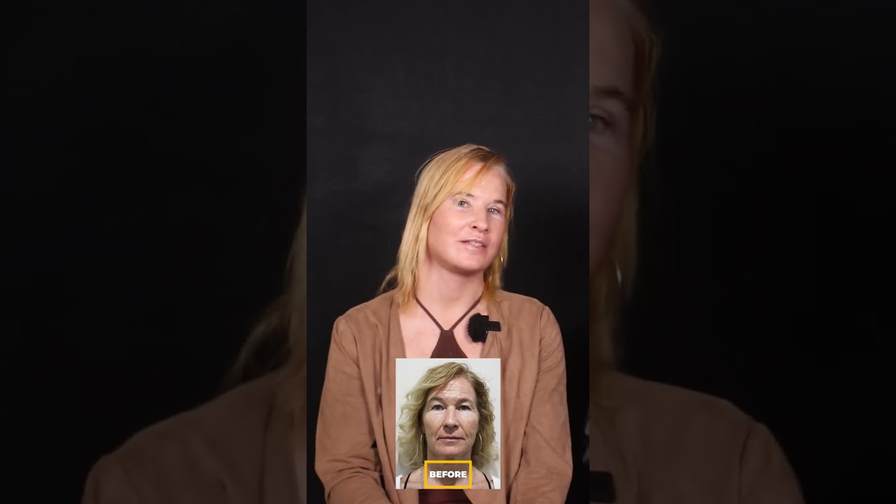Dr. Anand’s Expertise: Astrid’s Youthful Glow After Facelift & More | MedTrust