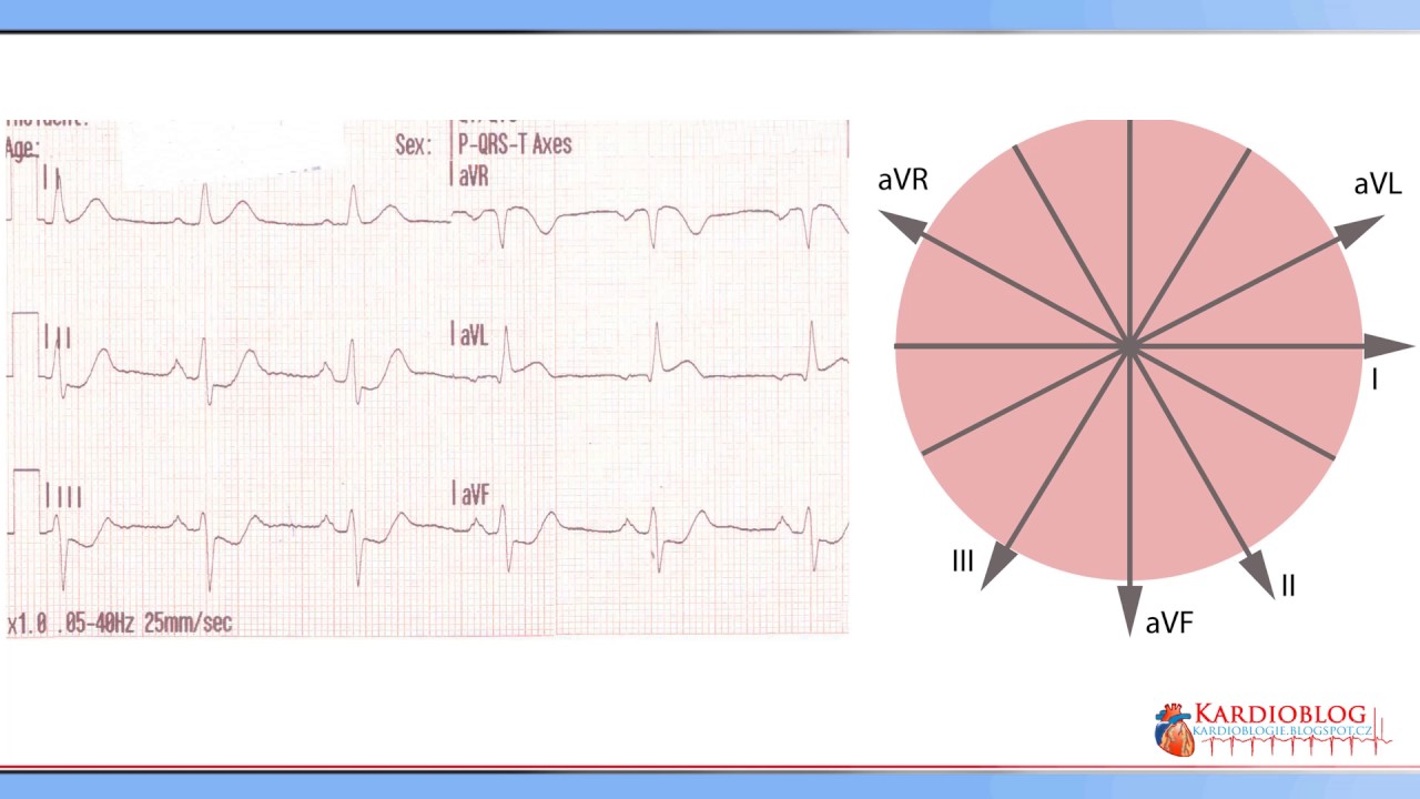 Kardioblog - EKG Kazuistika Bolesti na hrudi