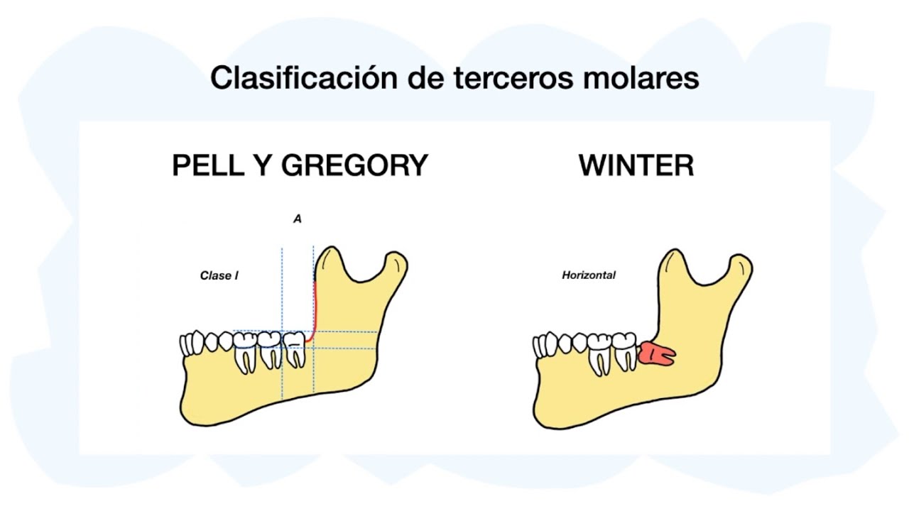 PELL Y GREGORY - WINTER: Clasificación terceros molares 🦷✅