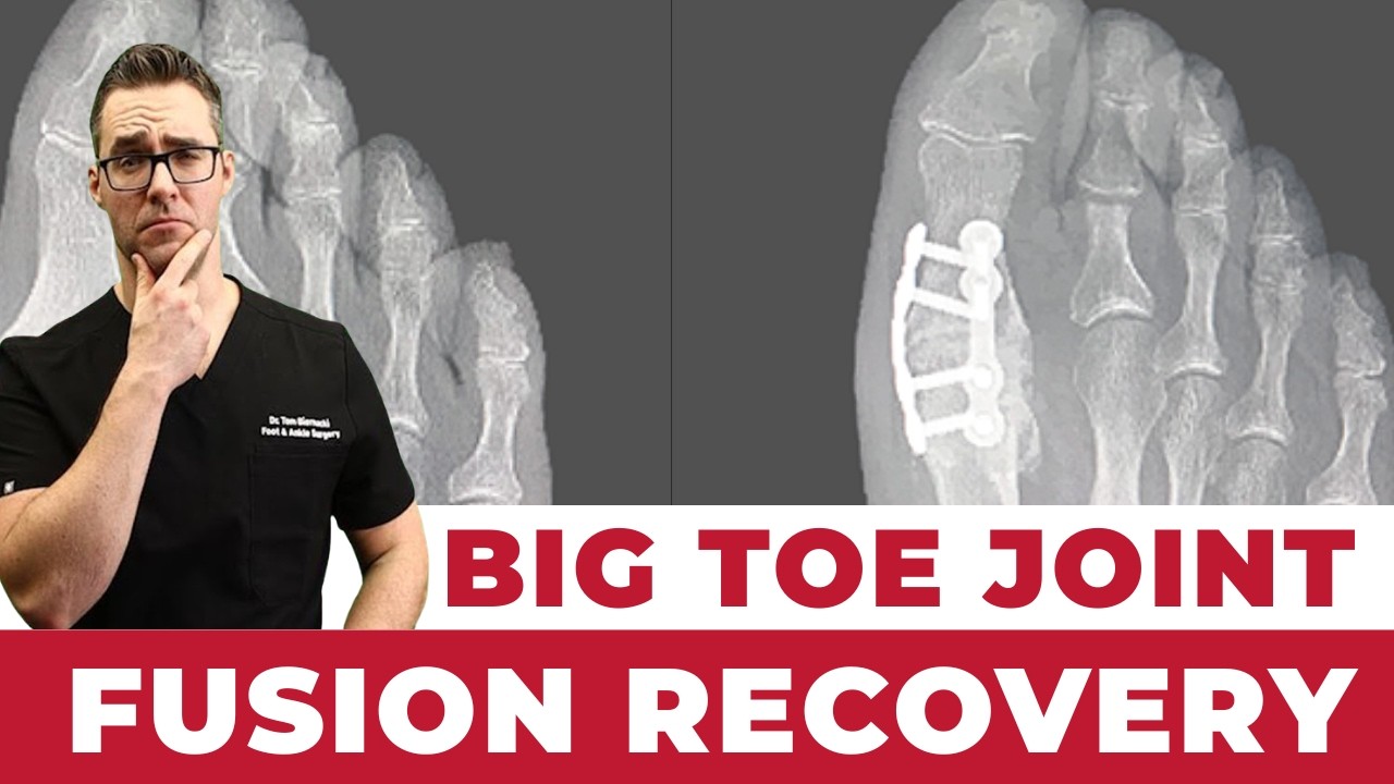 Big Toe Joint (MTP) Fusion Recovery ** Pros and Cons**