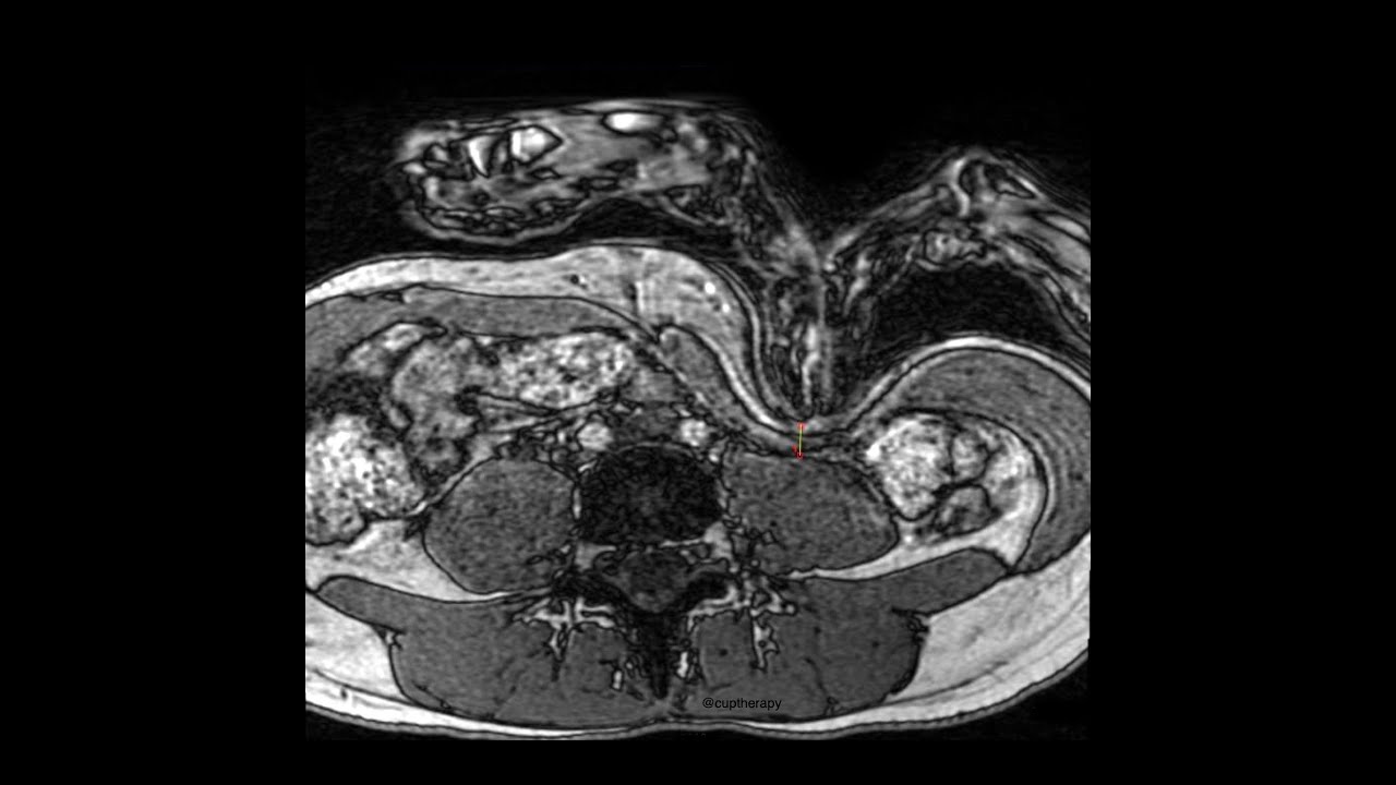 TTP 159: Can You Really Palpate the Psoas? (with Christopher DaPrato)