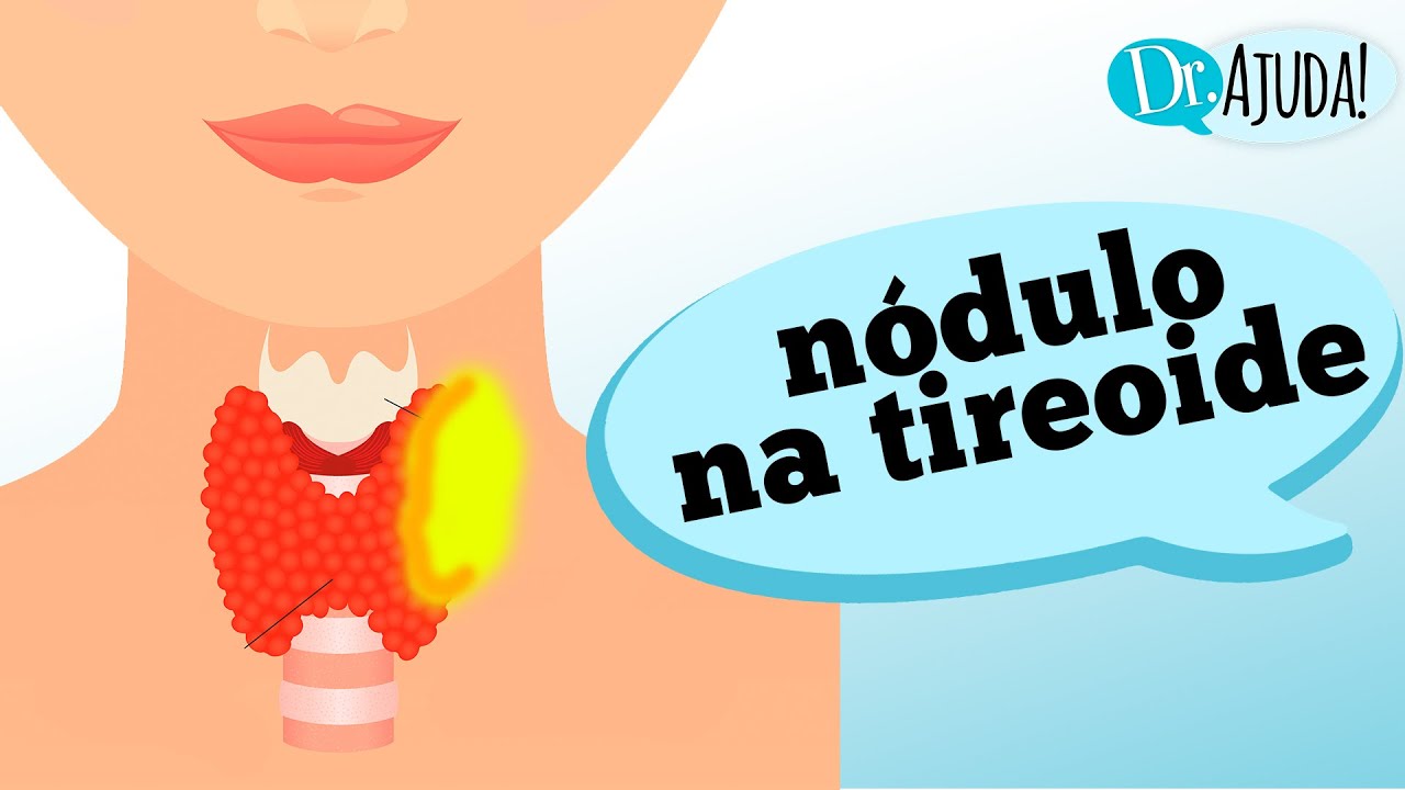 Quais os sintomas do N&Oacute;DULO NA TIREOIDE?