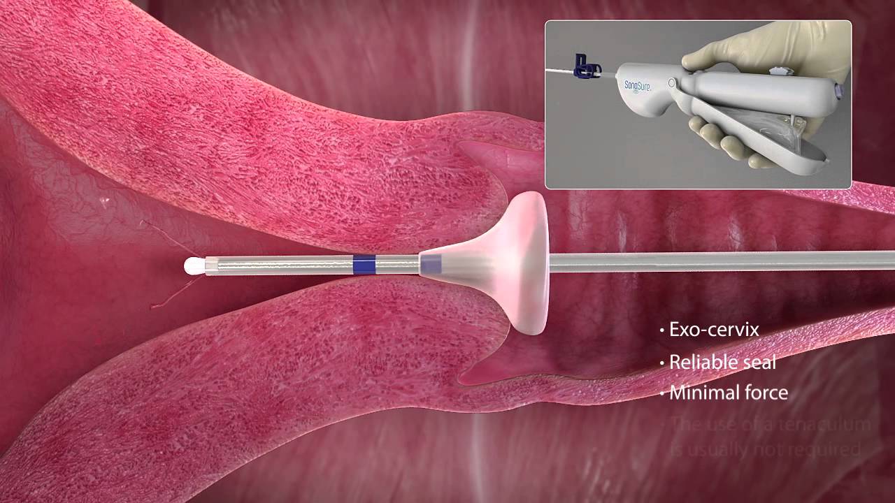 SonoSure animation