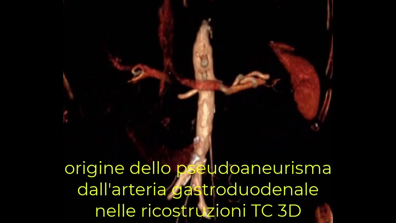 Embolizzazione arteria gastroduodenale con tecnica sandwich