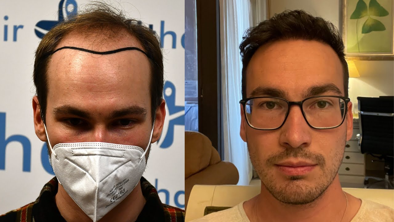 Hair Transplant Before and After - Month by Month results Elithair