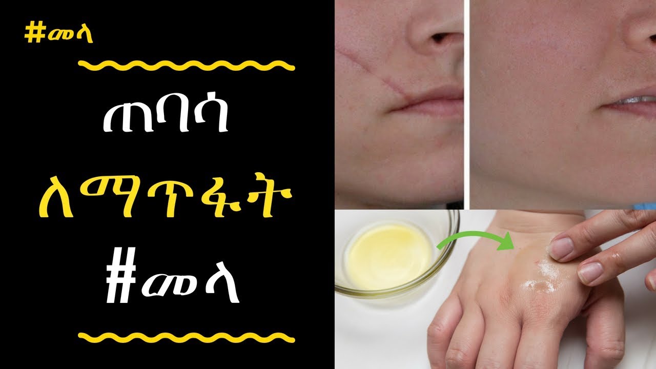 ETHIOPIA - የቆየ ወይም አዲስ ጠባሳን ለማስለቀቅ የሚረዱ የቤት ውስጥ መላዎች