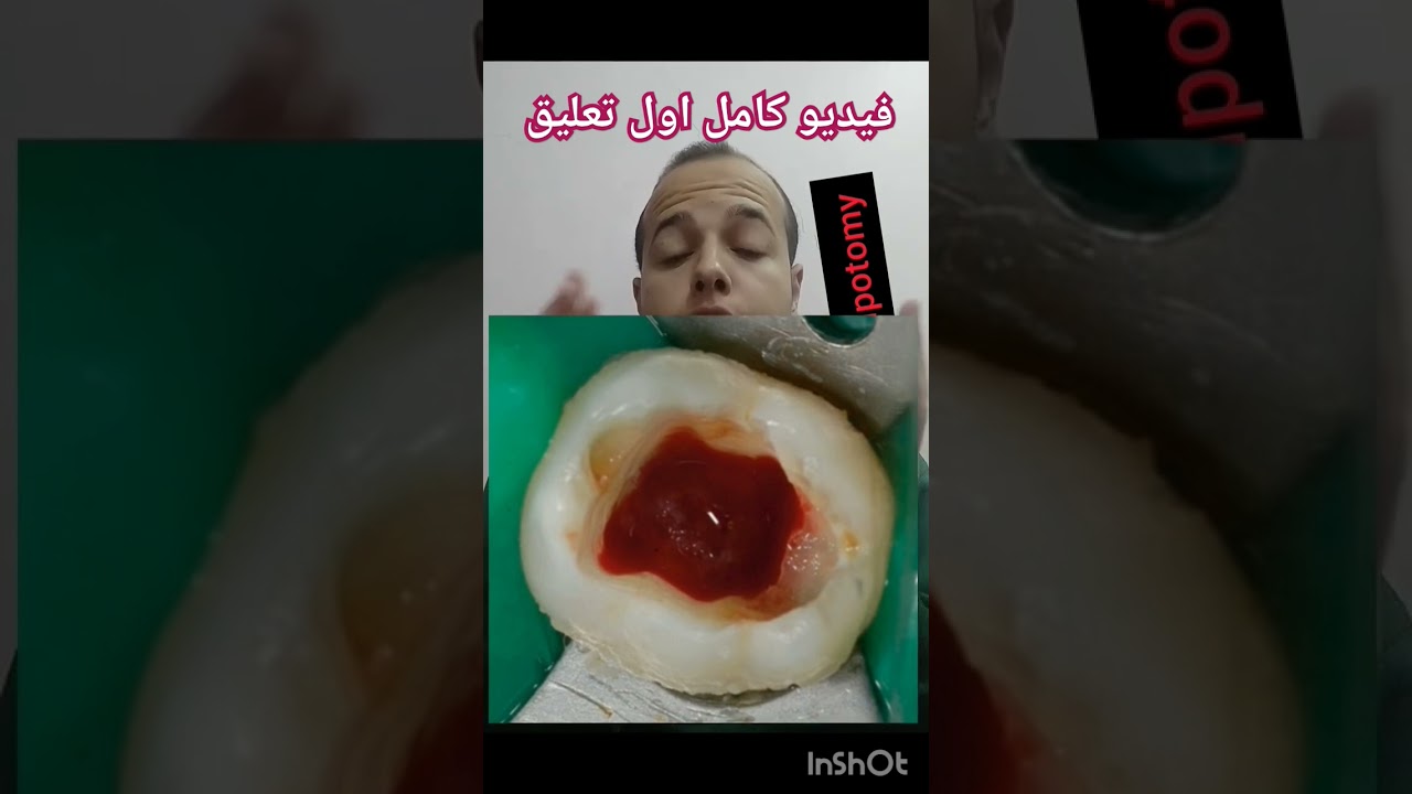 #pulpotomy#dental #pediatrics