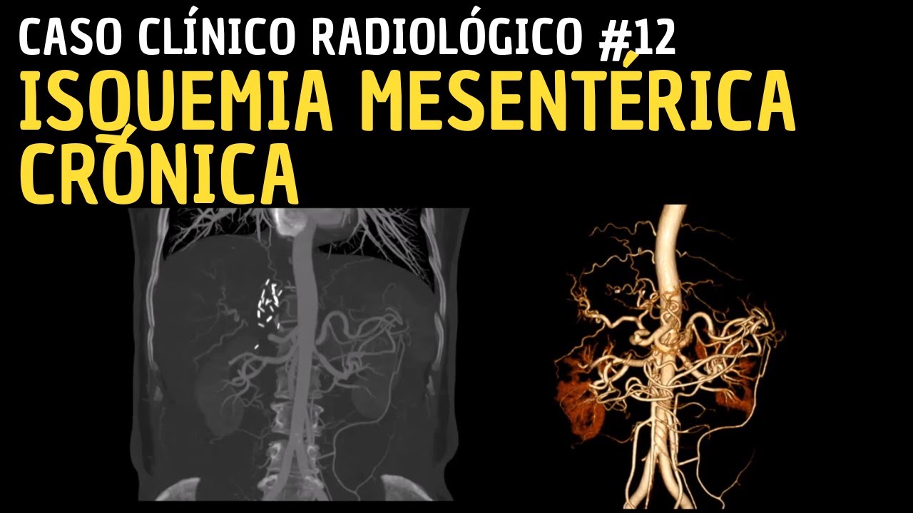 Caso Clínico 12: Isquemia Mesentérica Crónica.